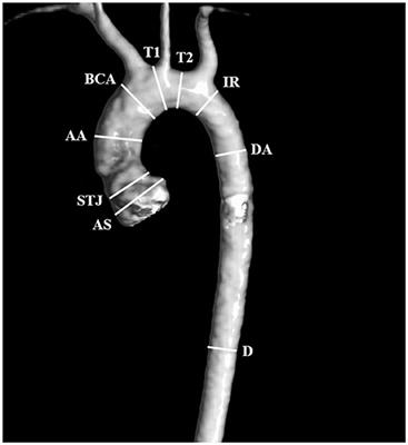 The Usefulness of Magnetic Resonance Imaging of the Cardiovascular System in the Diagnostic Work-Up of Patients With Turner Syndrome